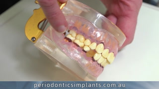 What is periodontitis and how is it treated?