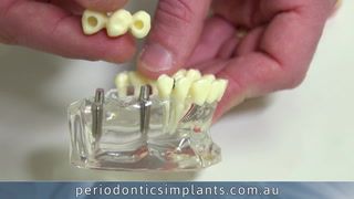 Options for Replacing Multiple Teeth