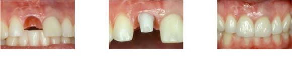 Replacing a single tooth with a dental implant