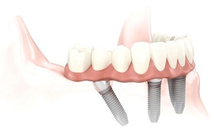 Fixed denture implants