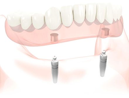 Removable denture implants