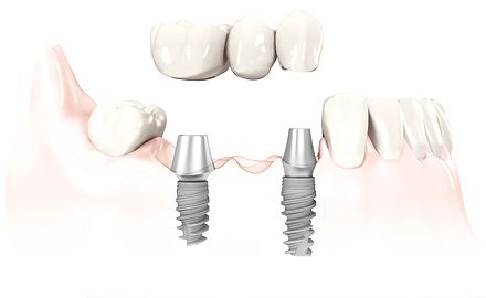 Dental implant bridge diagram
